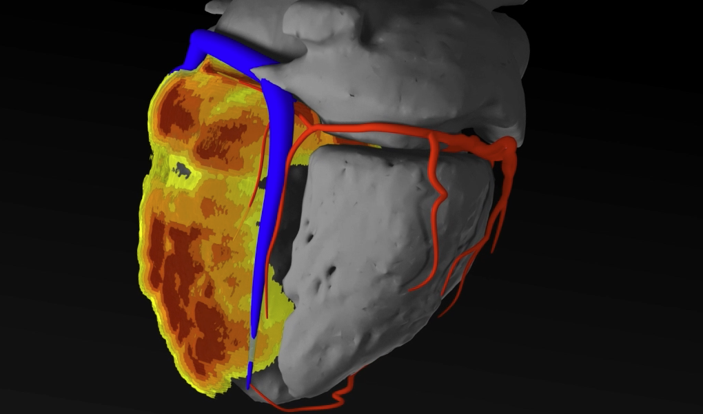 Image de l'évenement inHEART lève 3,7 M€ pour lutter contre les arythmies cardiaques