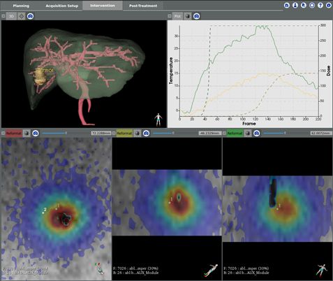 Image de l'évenement Certis Therapeutics lève 1,5 M€ pour améliorer la précision des chirurgies