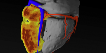 inHEART lève 3,7 M€ pour lutter contre les arythmies cardiaques