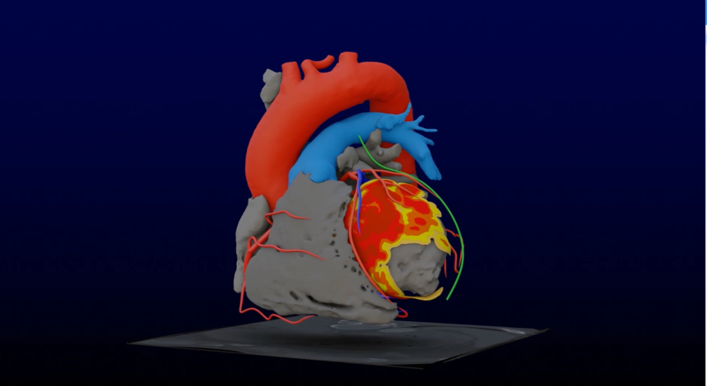 arythmie cardiaque